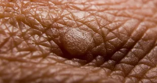 What is a Wart, How is it Treated, and What Happens if Not Treated?