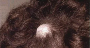 Why Does a Sebaceous Cyst Form on the Head, and How Is It Treated?