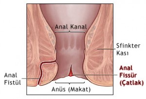 Anal Fissür