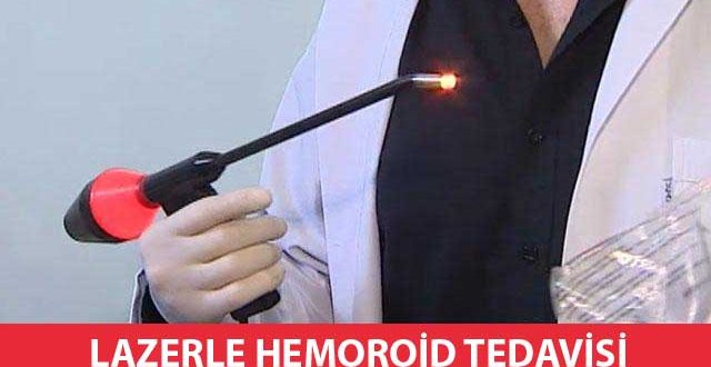 Lazerle Hemoroid (Basur) Tedavisi 510 Dakikada Mümkündür