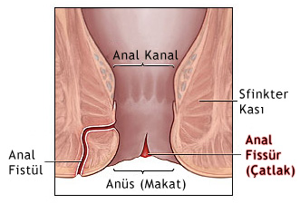 Makat çatlağı neden olur