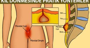 kıl dönmesi tedavisi