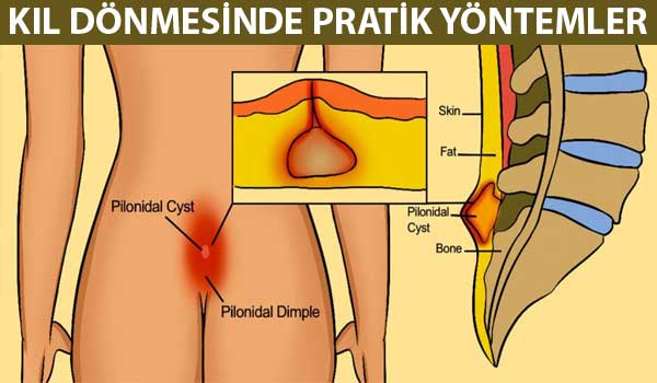 kıl dönmesi tedavisi