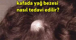 kafada yağ bezesi nasıl tedavi edilir